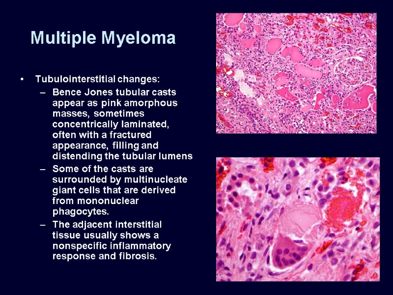 Multiple Myeloma Tubulointerstitial changes: Bence Jones tubular casts appear as pink amorphous masses, sometimes